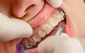 Пластины на зубы по недорогой цене: особенности современной медицины